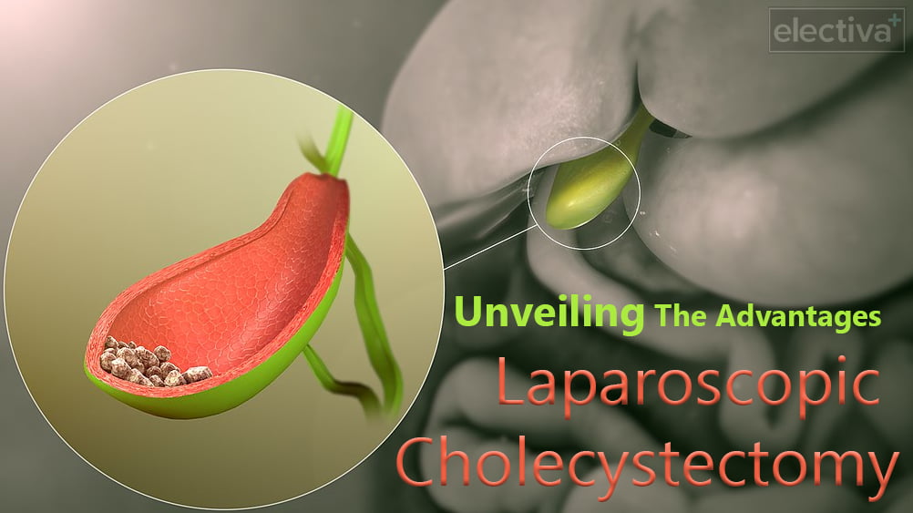 Unveiling the Advantages Exploring the World of Laparoscopic Cholecystectomy