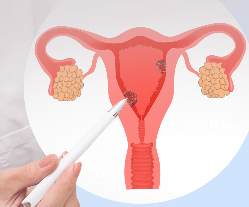 https://electiva.com/wp-content/uploads/2023/05/endometrial-ablation-mobile.png